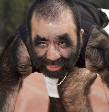 Ю Чжэнхуань: самый волосатый человек в мире